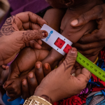 Acute malnutrition measurement 2